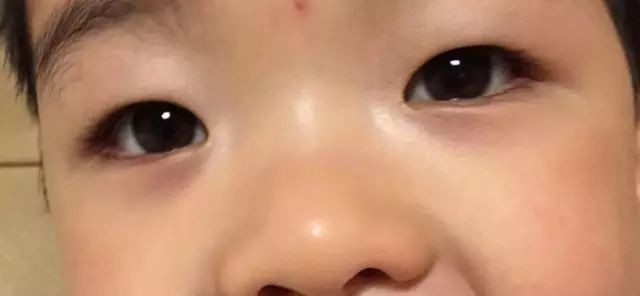 孩子出现这种眼袋妈妈就该注意了