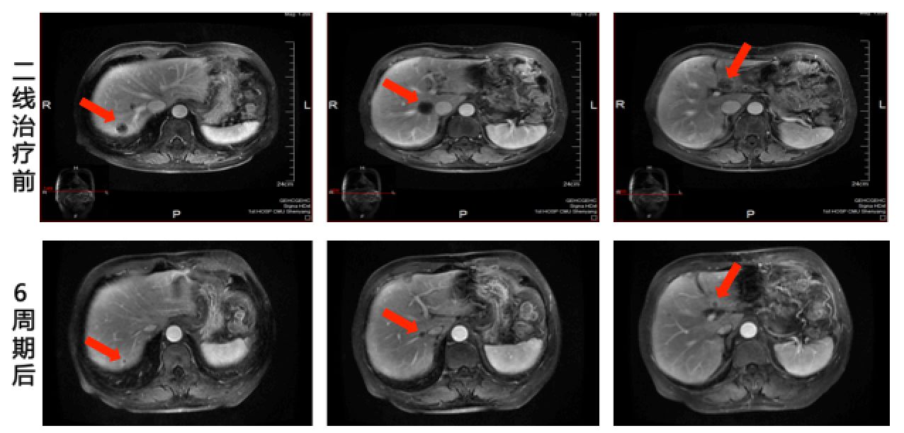 二线治疗前及6周期后腹部ct对比mdt讨论-肝胆外科:根据患者影像学