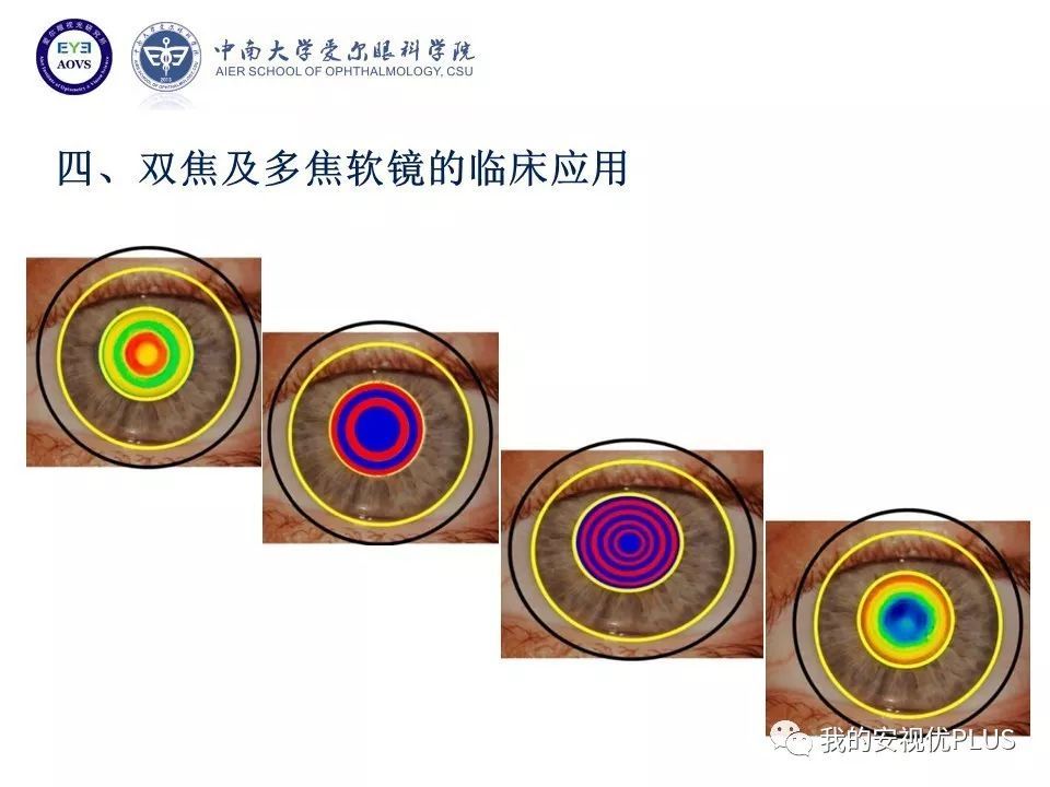 黄锦海博士在比较16种近视矫正方法中发现,双焦或多焦软镜对近视亦有