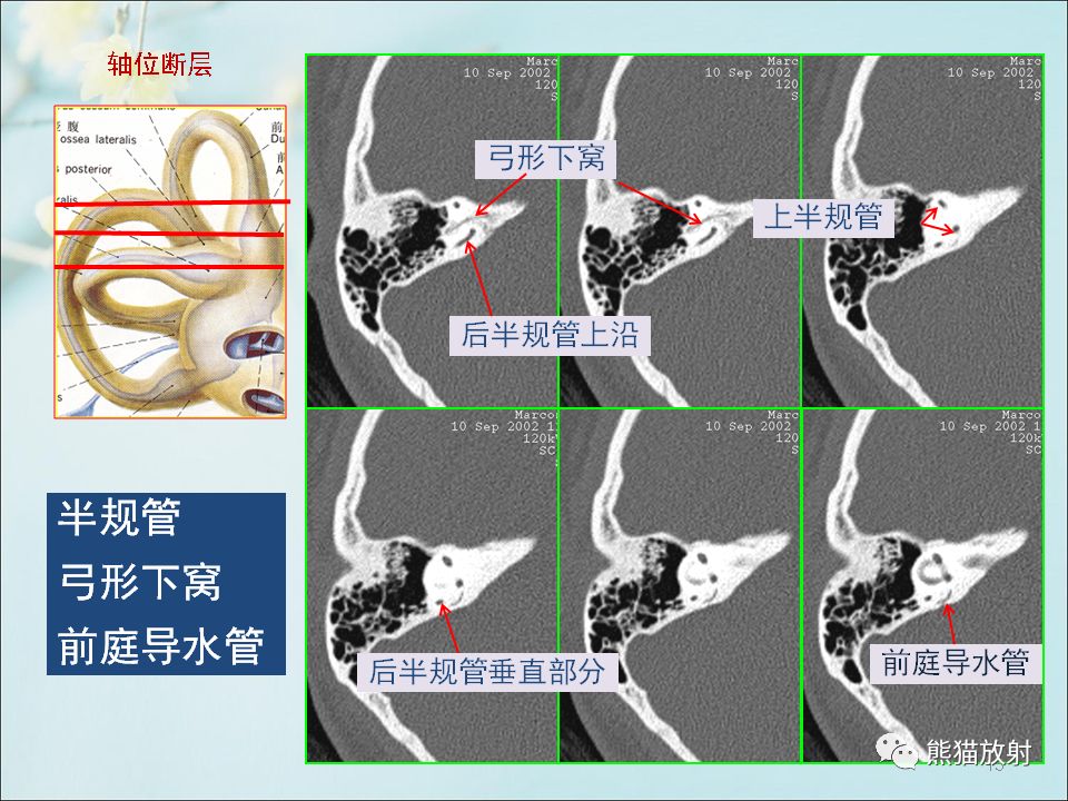 柳澄讲坛颞骨ct断层解剖第一部分连续断层