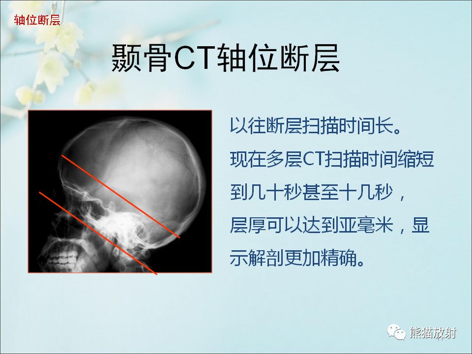 颞骨核磁图片