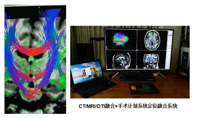 第五代腦立體定向技術(dti ct mri定位成像系統)