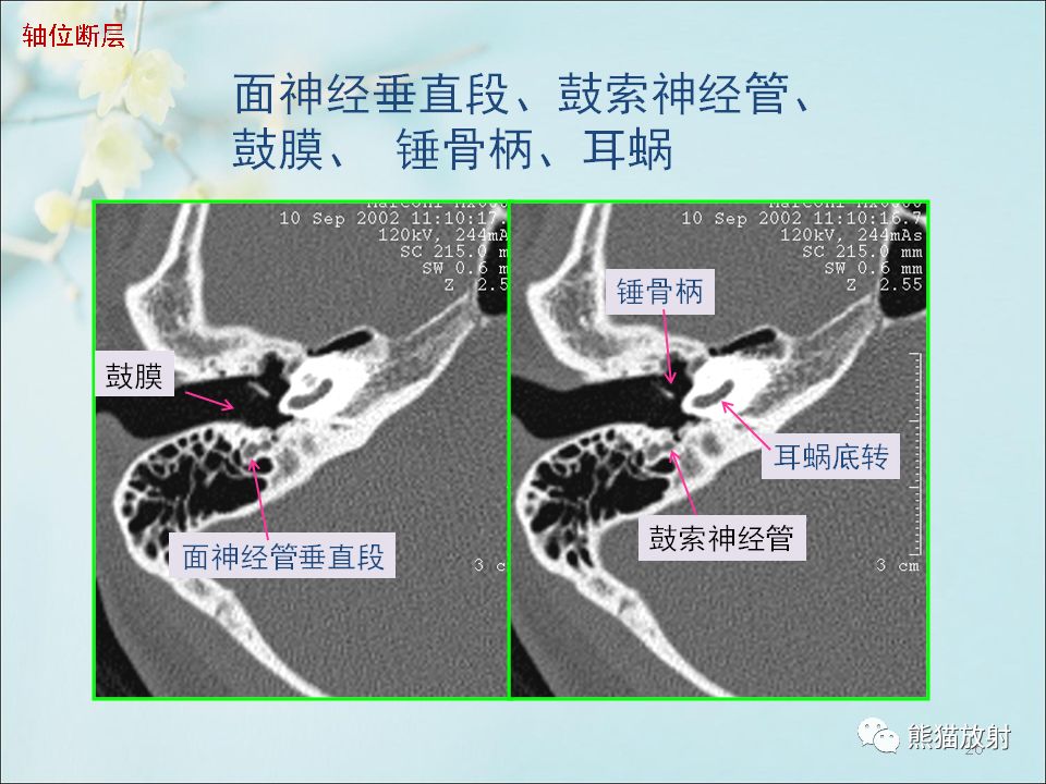 柳澄讲坛颞骨ct断层解剖第一部分连续断层