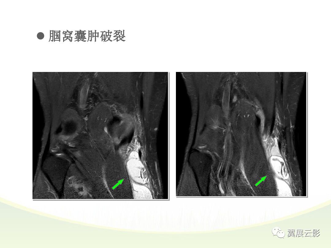 膝关节滑膜病变mri表现