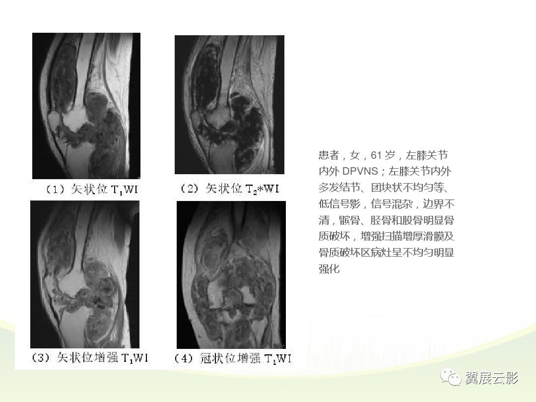 膝關節滑膜病變mri表現