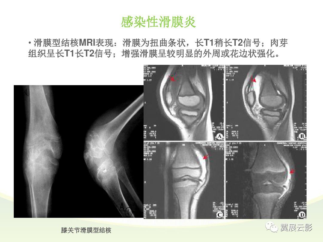 膝关节滑膜炎磁共振图片