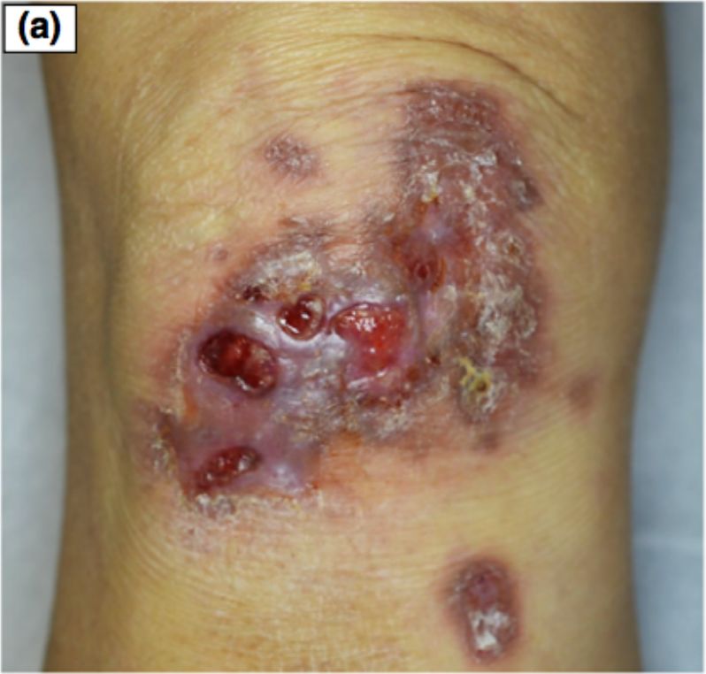 膝盖化脓感染的图片图片