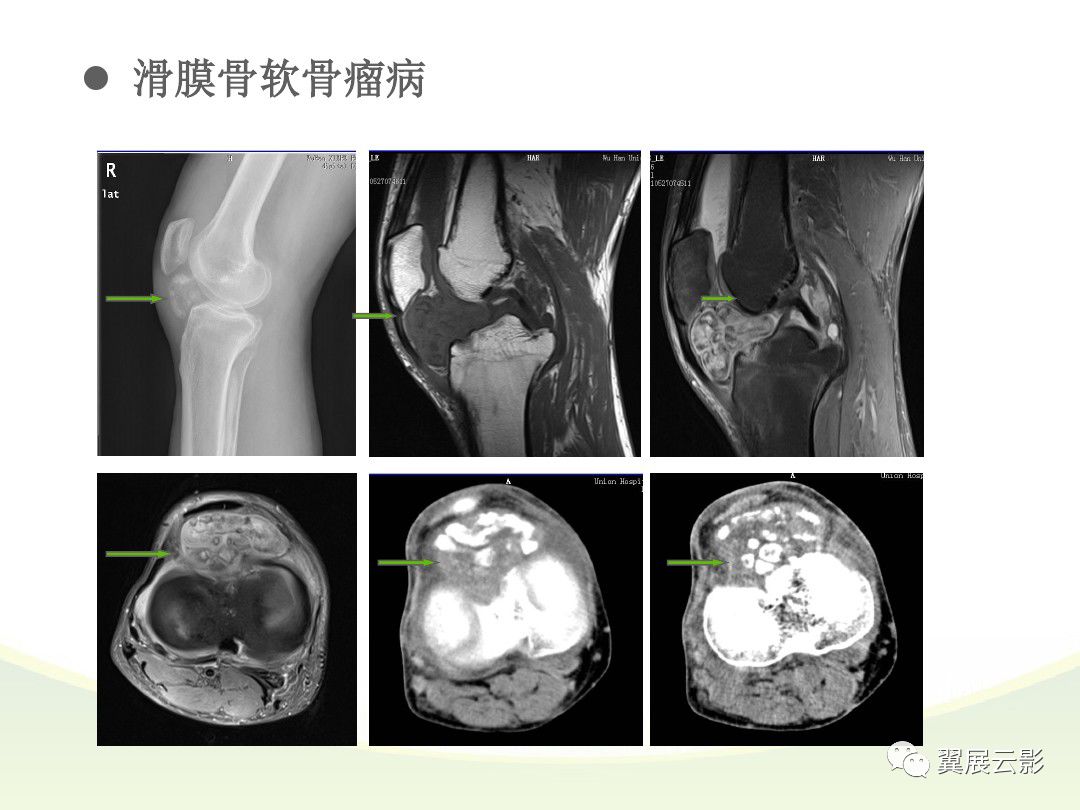 滑膜炎 核磁共振图片