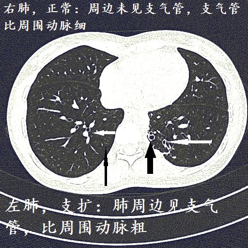 經典圖譜詳細解說支氣管擴張ct小訣竅學不會我拜你為師