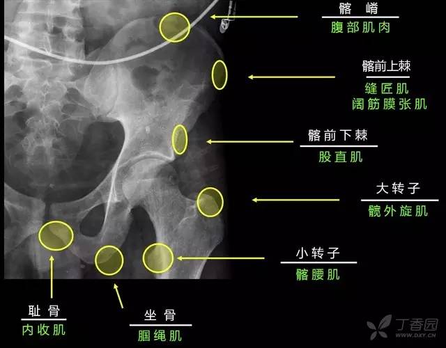 髂耻线解剖图图片