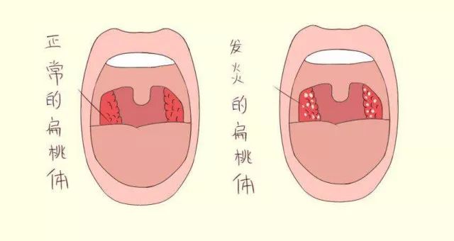健康科普京都耳鼻喉科专家专访关于小儿扁桃体发炎的那些事儿