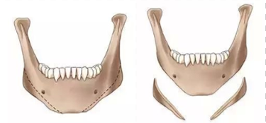 下頜角整形的手術方式(下頜角骨質去除方法).
