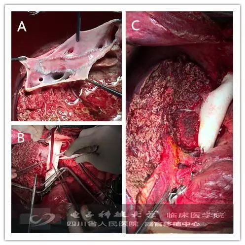 手術解析複雜肝佔位離體肝切除自體肝移植術