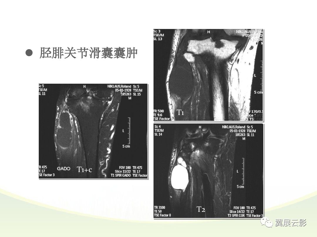 膝關節滑膜病變mri表現