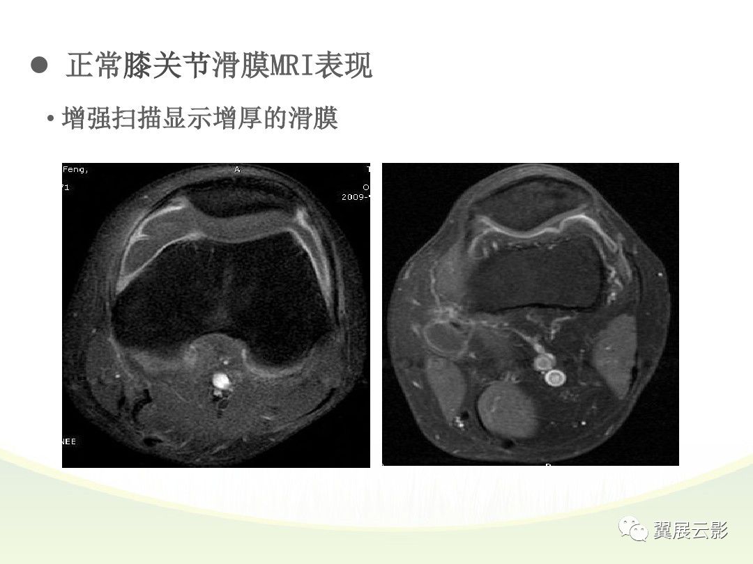 滑膜炎 核磁共振图片