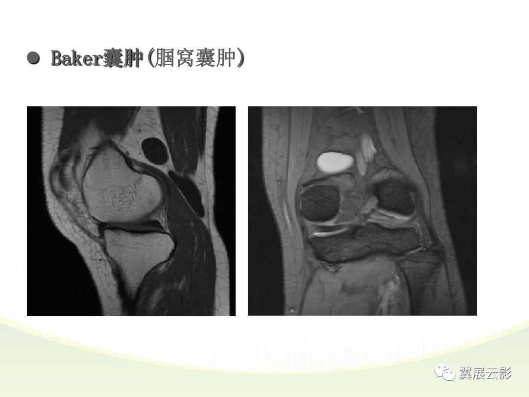 膝关节滑膜炎磁共振图片