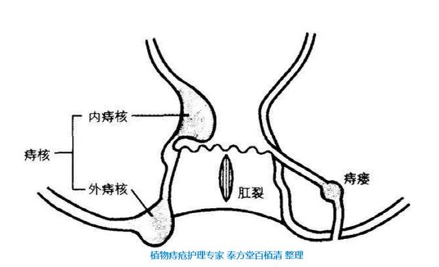 痔疮,肛裂,肛瘘?痔疮到底咋回事?图示告诉你!收藏!转发!