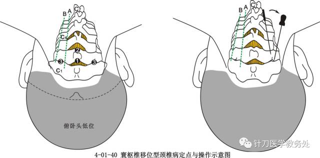 寰齿关节错位型颈椎病