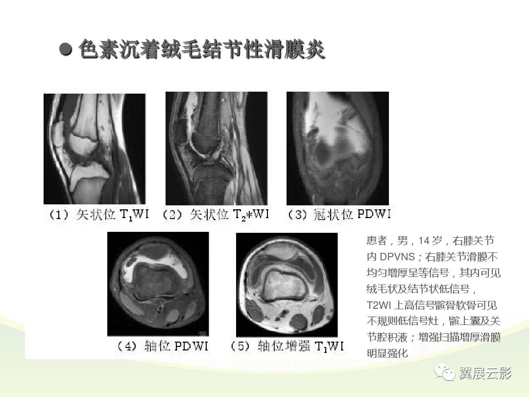 膝關節滑膜病變mri表現