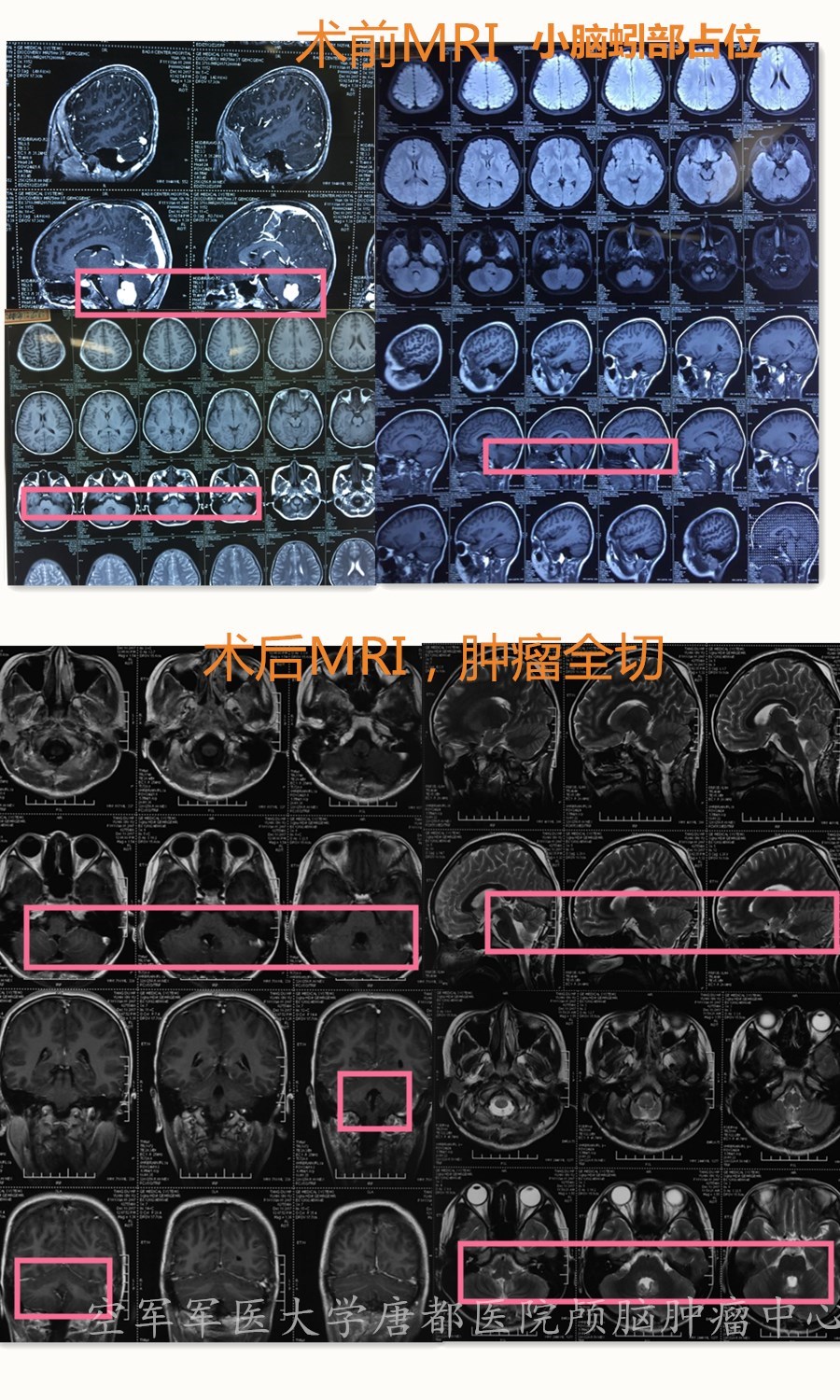 小脑蚓部髓母细胞瘤图片