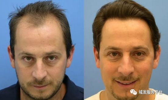 额角植发前后对比图台湾艺人黃仲崑额角植发前后对比图在植发医生看来