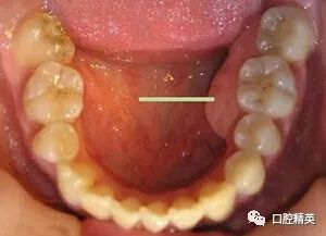牙齿长骨刺的症状图片图片