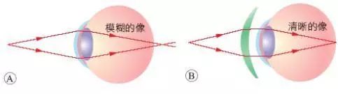 正視眼近視眼遠視眼有什麼不同