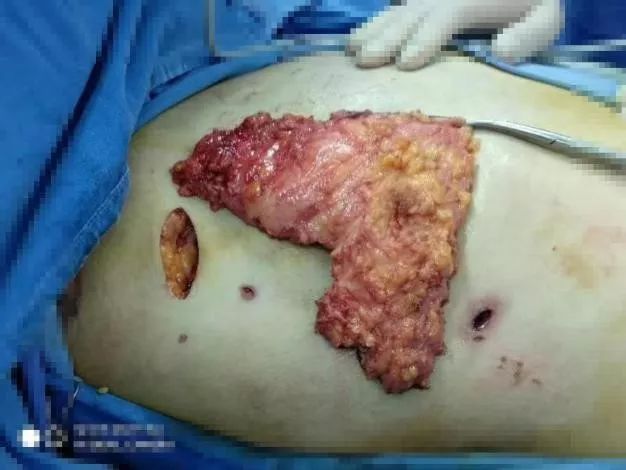 乳房全切手术乳腺癌图片