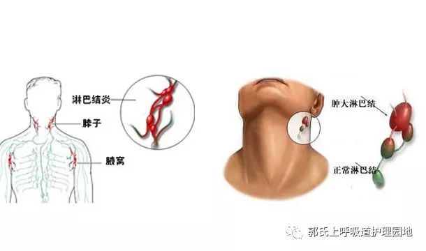 郭氏咽扁保健散使用视频详解