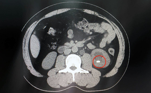 左肾结石图片