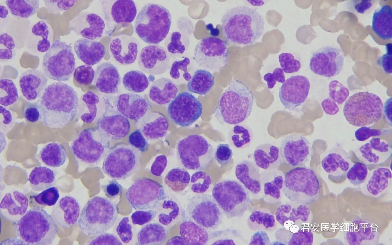 漫漫诊断路——慢性粒单核细胞白血病