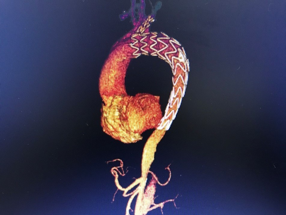 胸主动脉瘤介入支架图片