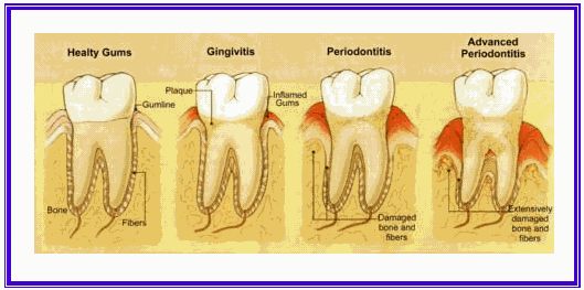 牙周炎属于慢性支持组织炎症,炎症涉及的范围也是慢慢扩散,不在乎这些