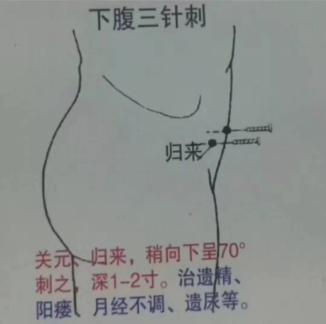 各种刺法没有文字只有图看图学针灸