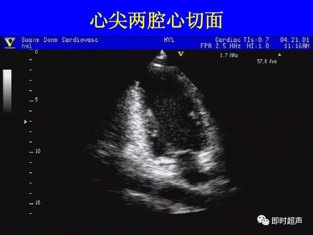 心脏超声肺静脉切面图片