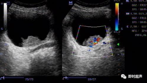 膀胱癌的超声影像诊断分析