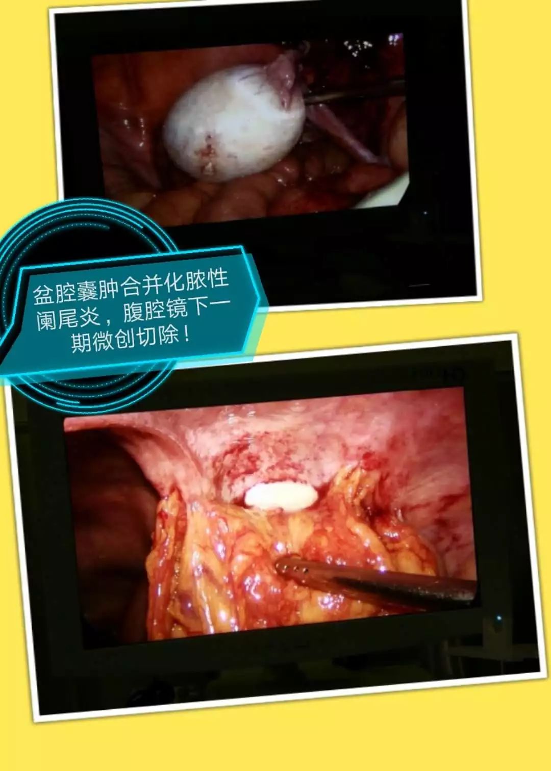 盆腔囊肿图片腹腔镜图片