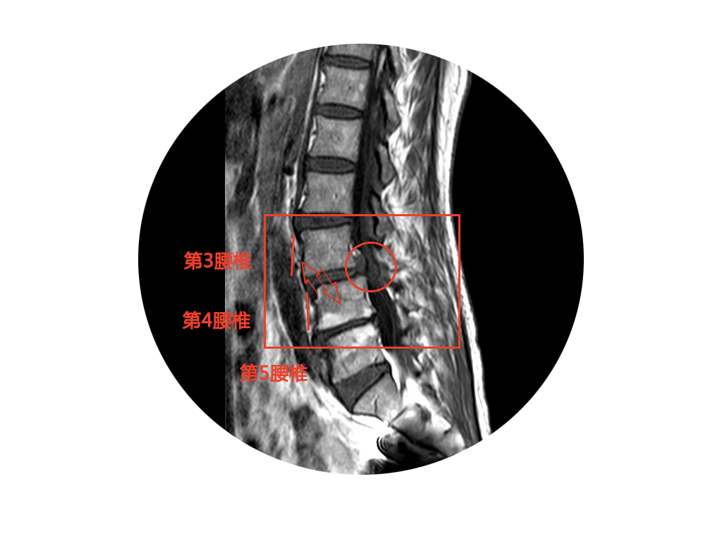 診斷:腰椎退行性滑脫,腰椎管狹窄並椎間盤脫出在經過與患者及其家屬的