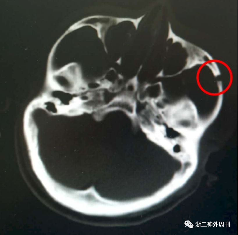 图6 术后ct骨窗显示颧弓前份少量骨质缺如