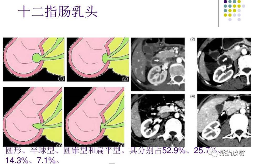 各種十二指腸良惡性腫瘤影像圖附病例