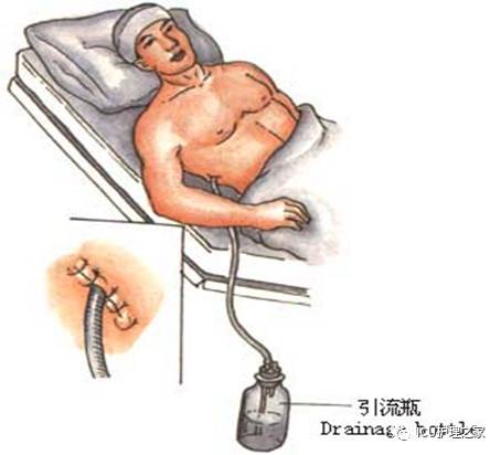 胆囊切除术体位图片