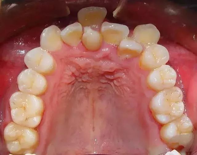 牙齿畸形种类图片图片