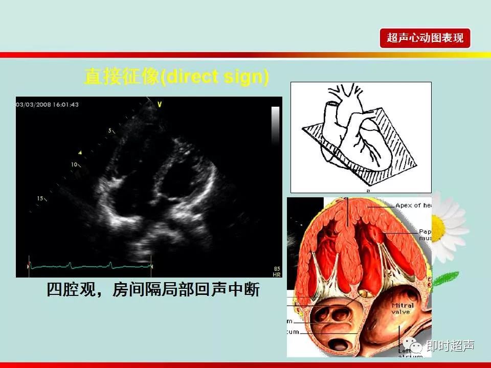 房间隔缺损的超声诊断