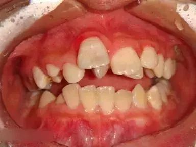 牙齿畸形难看图片