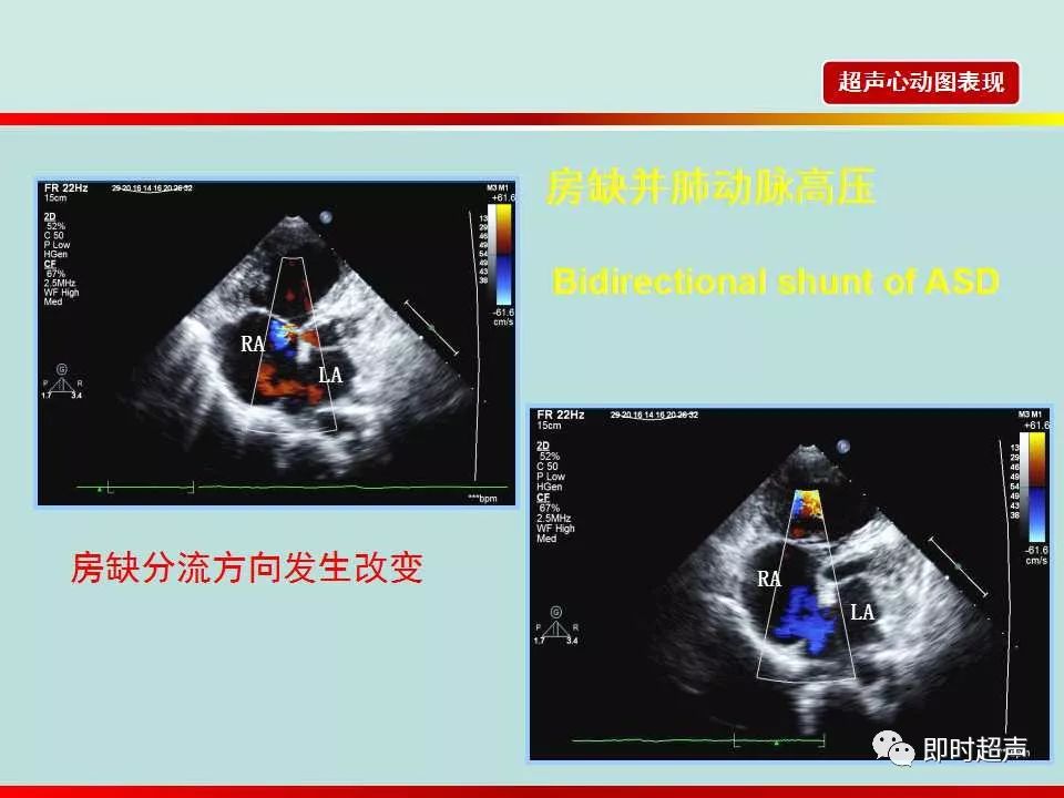 房间隔缺损的超声诊断