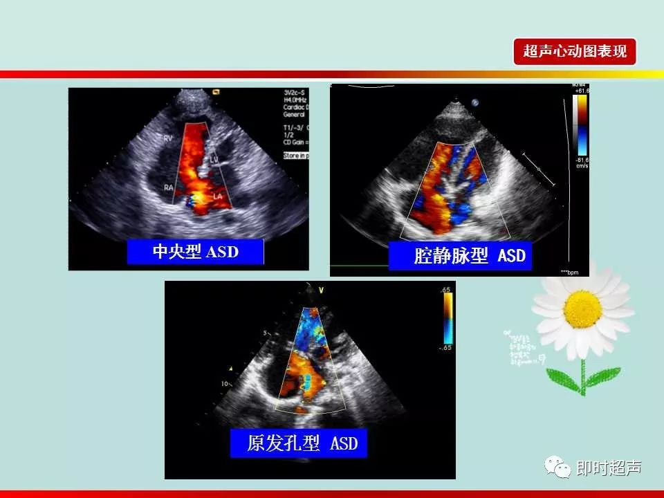 房间隔缺损的超声诊断