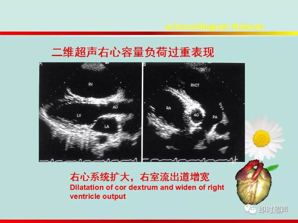 室间隔缺损超声图解图片