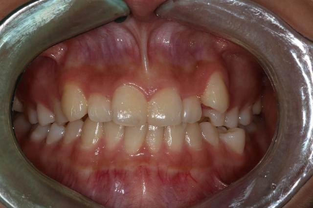 可爱的虎牙有可能成为可怕的口腔隐患