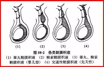 3 交通性鞘膜积液2 睾丸鞘膜积液1