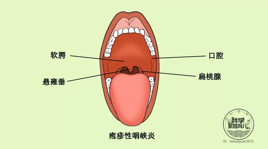 主要是在口腔里,软腭上和扁桃腺,悬雍垂上出现小疱疹,症状有发热,咽痛